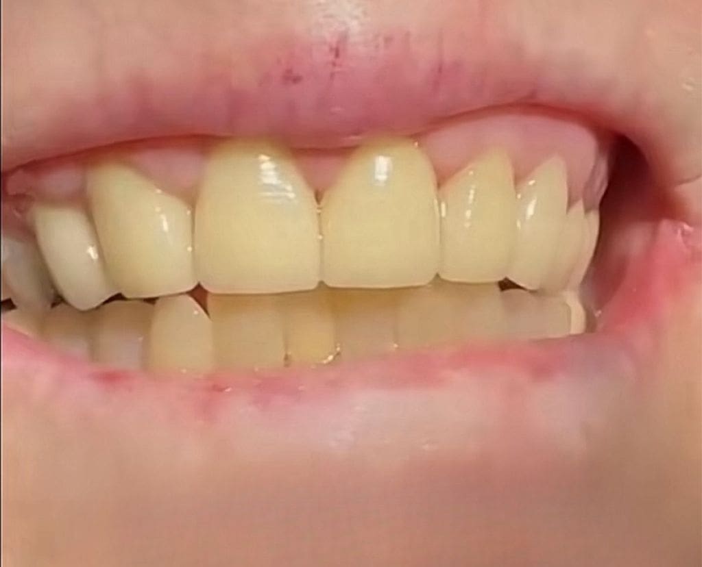 A close up of teeth with yellow and white fillings