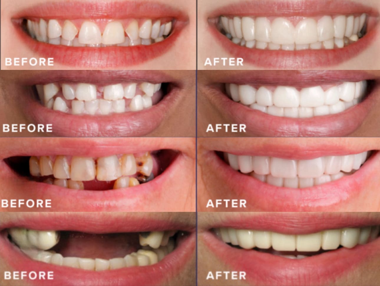 A woman 's teeth are shown before and after dental treatment.